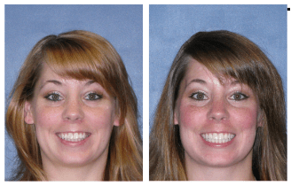 Woman's smile before and after Invisalign