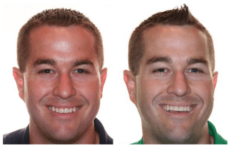 Before and after treatment with Invisalign of a man