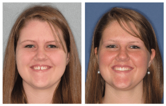 Woman's before and after Invisalign treatment