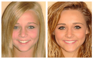 Young woman's smile before and after Invisalign